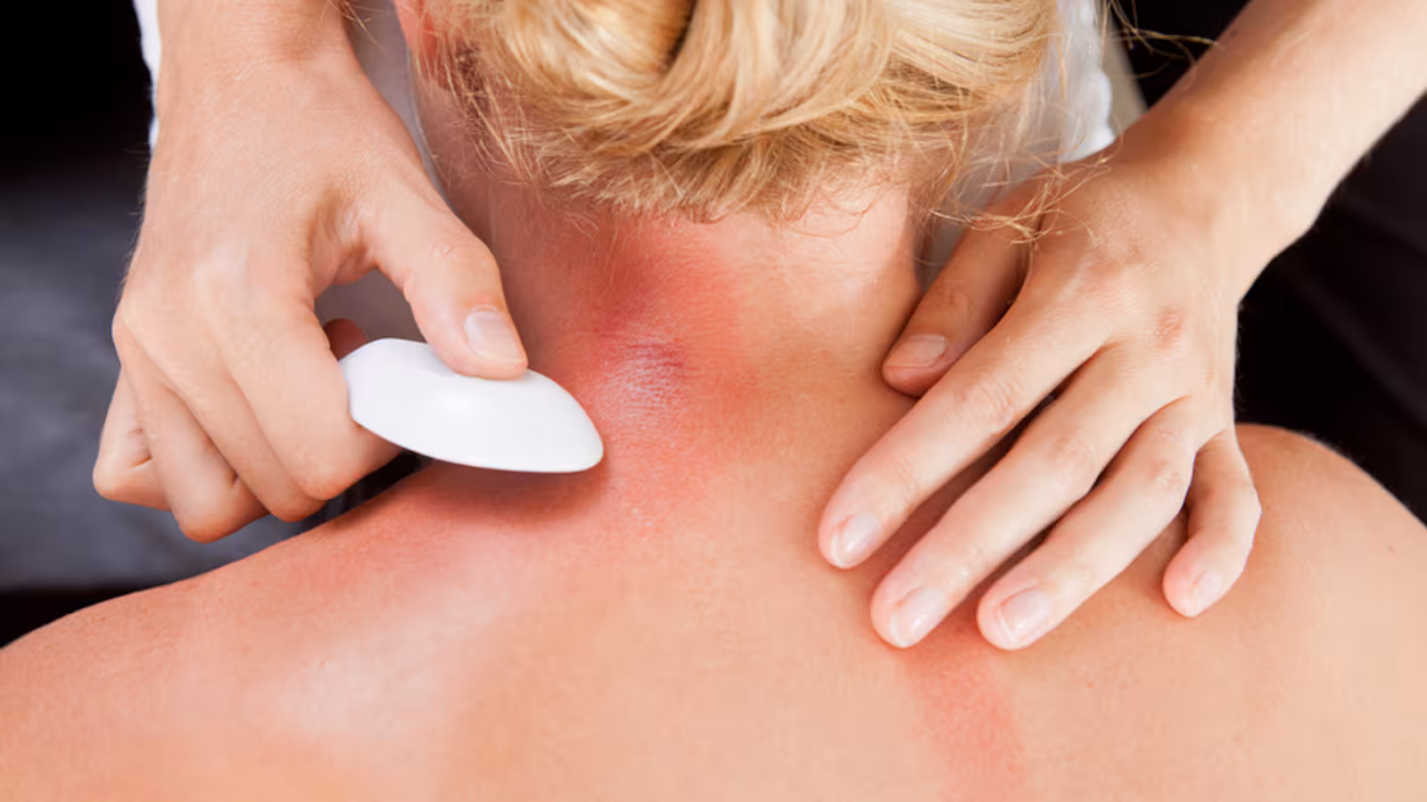 Gua sha as part of acupuncture