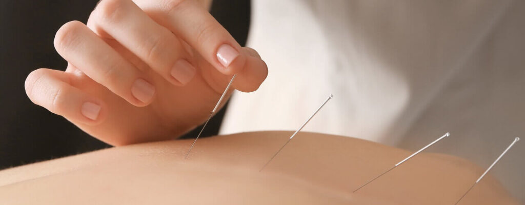 Acupuncture treatment in a relaxing setting
